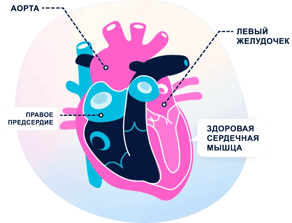 Heart illustration showing heart failure results